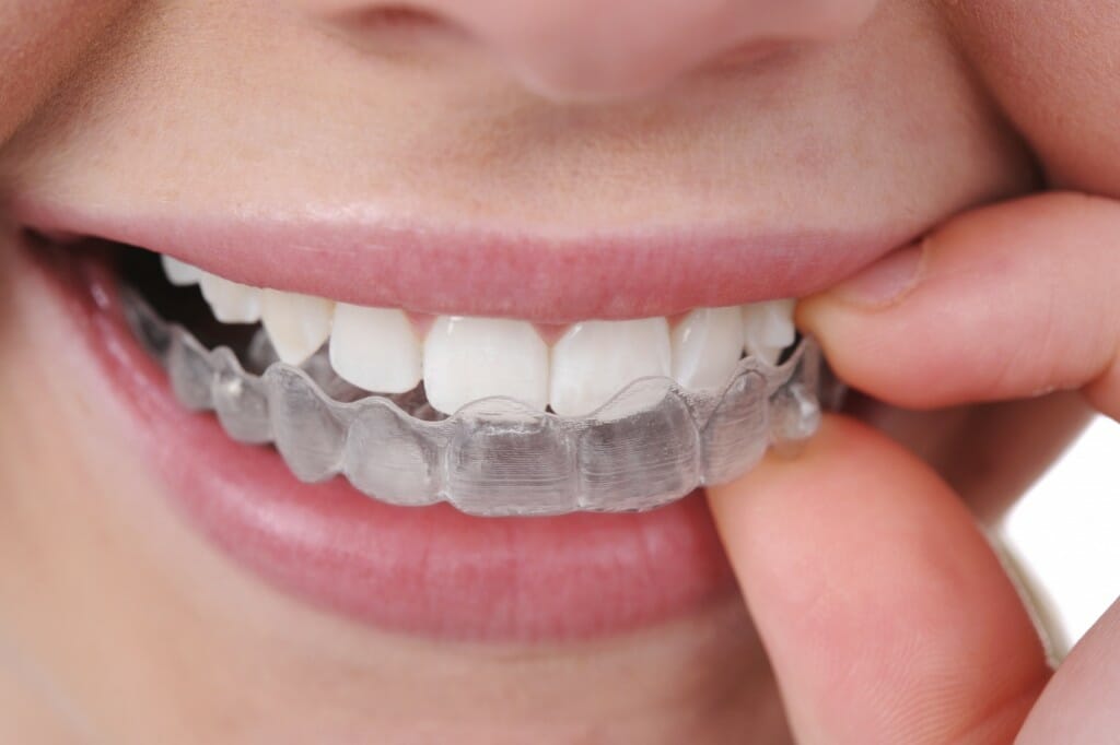 Invisalign clear braces