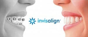 Get invisalign in collierville for clear braces as an alternative to traditional braces